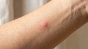 Understanding a yellow sac spider bite — a single red bump with a puncture mark and slight inflammation on human skin